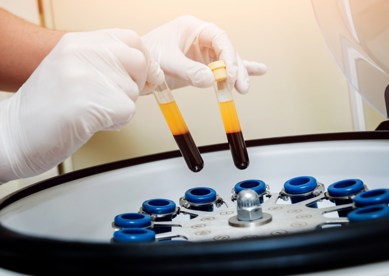 난소 PRP 이미지